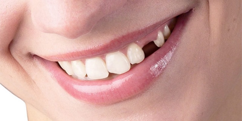 Cần làm gì sau giấc chiêm bao thấy rụng răng?